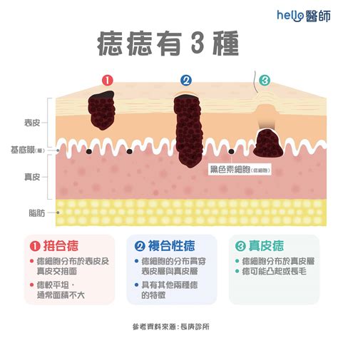 身體的痣|為什麼臉上的痣越來越多？皮膚科醫師解析長痣原因、。